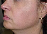 ThermaCool Non-Surgical Facelift Before & After Image