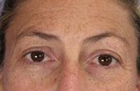 ThermaCool Non-Surgical Facelift Before & After Image