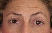 ThermaCool Non-Surgical Facelift Before & After Image