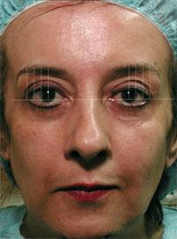 ThermaCool Non-Surgical Facelift Before & After Image