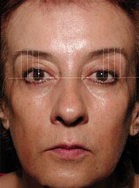 ThermaCool Non-Surgical Facelift Before & After Image