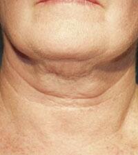 ThermaCool Non-Surgical Facelift Before & After Image