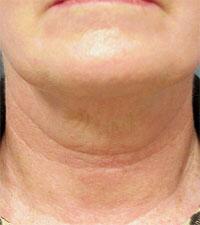 ThermaCool Non-Surgical Facelift Before & After Image