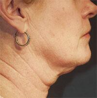 ThermaCool Non-Surgical Facelift Before & After Image
