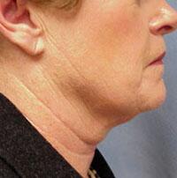 ThermaCool Non-Surgical Facelift Before & After Image