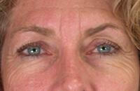 ThermaCool Non-Surgical Facelift Before & After Image