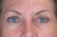 ThermaCool Non-Surgical Facelift Before & After Image