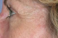 ThermaCool Non-Surgical Facelift Before & After Image