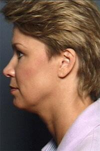 ThermaCool Non-Surgical Facelift Before & After Image