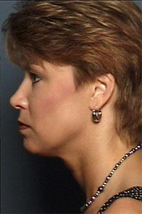 ThermaCool Non-Surgical Facelift Before & After Image