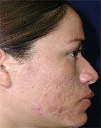 ThermaCool Non-Surgical Facelift Before & After Image