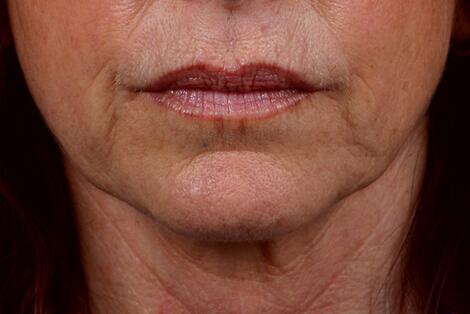 ThermaCool Non-Surgical Facelift Before & After Image