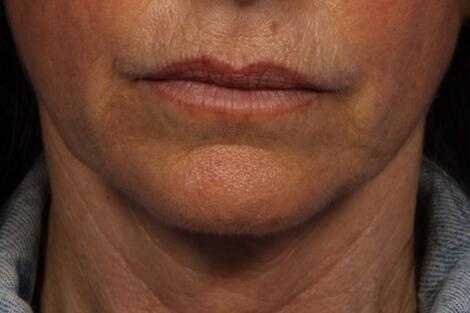 ThermaCool Non-Surgical Facelift Before & After Image