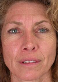 ThermaCool Non-Surgical Facelift Before & After Image