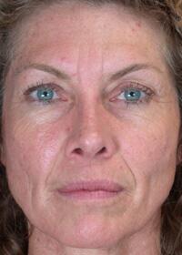 ThermaCool Non-Surgical Facelift Before & After Image