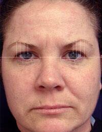 ThermaCool Non-Surgical Facelift Before & After Image