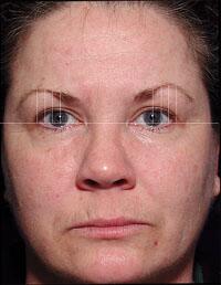 ThermaCool Non-Surgical Facelift Before & After Image