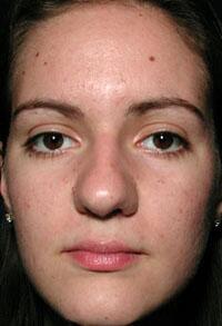 ThermaCool Non-Surgical Facelift Before & After Image