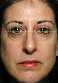 ThermaCool Non-Surgical Facelift Before & After Image