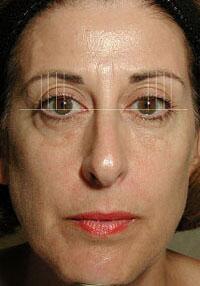 ThermaCool Non-Surgical Facelift Before & After Image