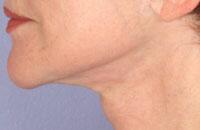 ThermaCool Non-Surgical Facelift Before & After Image