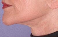 ThermaCool Non-Surgical Facelift Before & After Image