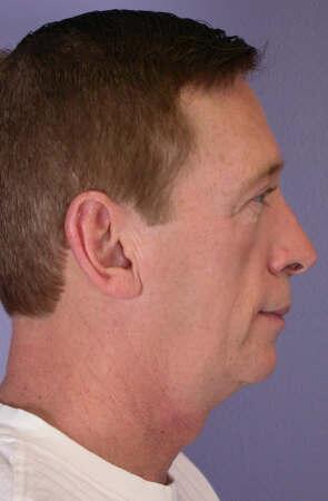 ThermaCool Non-Surgical Facelift Before & After Image