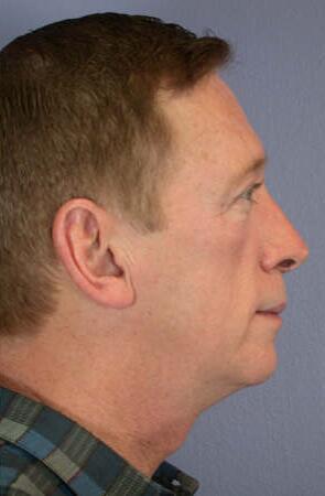 ThermaCool Non-Surgical Facelift Before & After Image