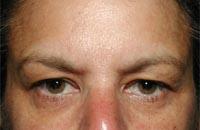 ThermaCool Non-Surgical Facelift Before & After Image