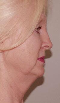 ThermaCool Non-Surgical Facelift Before & After Image