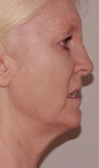 ThermaCool Non-Surgical Facelift Before & After Image