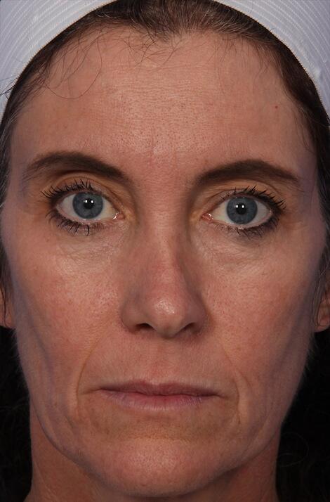 Thermage® Before & After Image