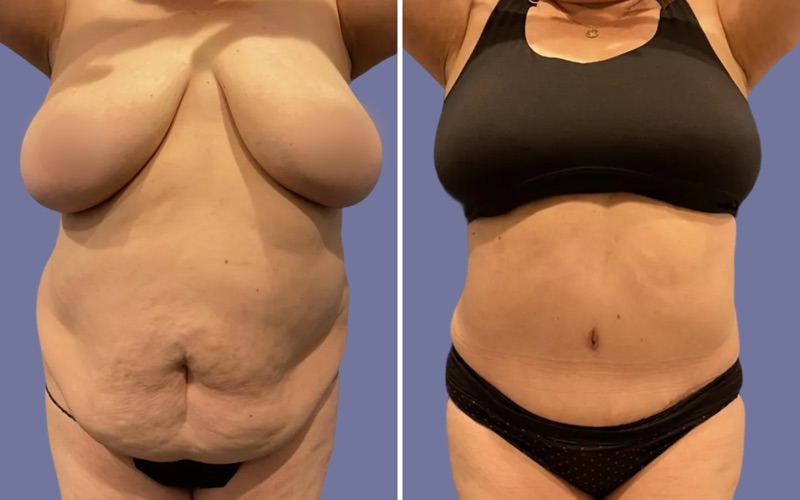 Tummy Tuck Before & After Image