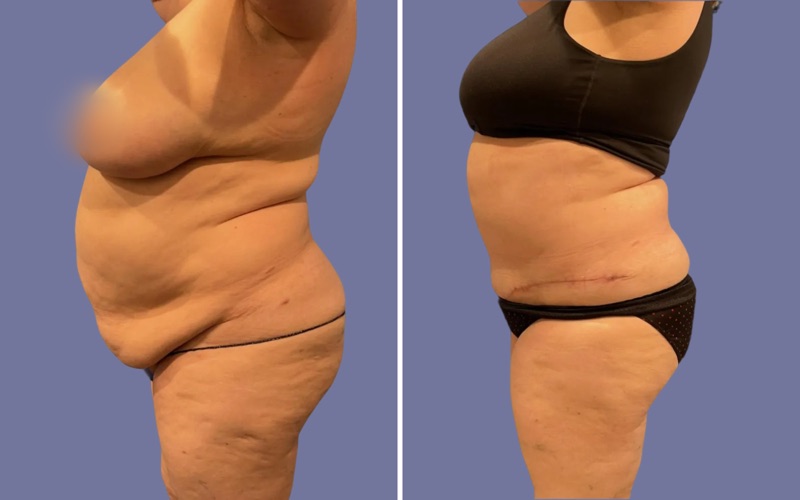 Tummy Tuck Before & After Image