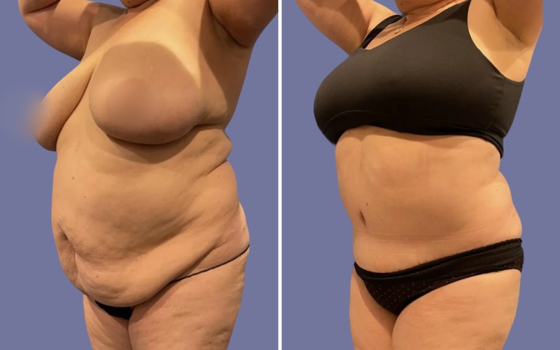 Tummy Tuck Before & After Image