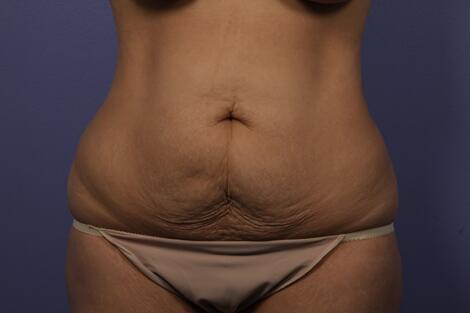 Tummy Tuck Before & After Image