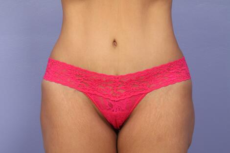 Tummy Tuck Before & After Image