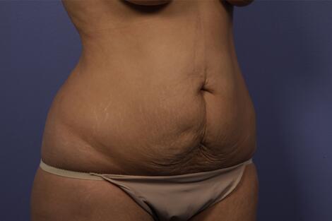 Tummy Tuck Before & After Image