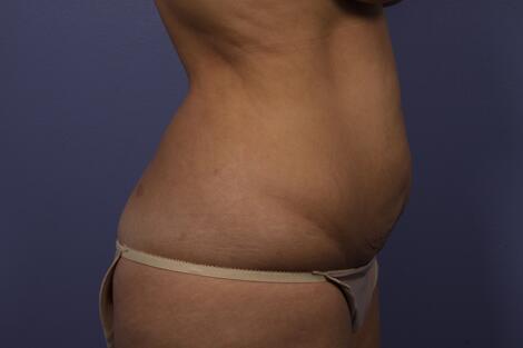 Tummy Tuck Before & After Image