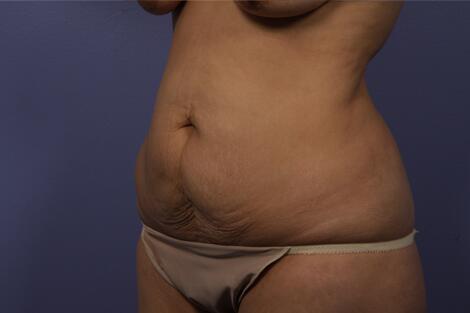 Tummy Tuck Before & After Image