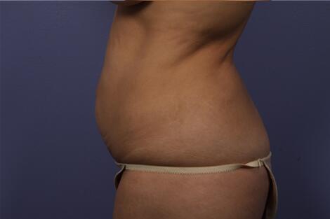 Tummy Tuck Before & After Image