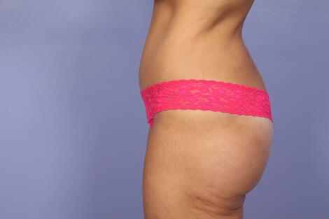 Tummy Tuck Before & After Image