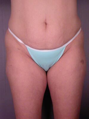 Tummy Tuck Before & After Image