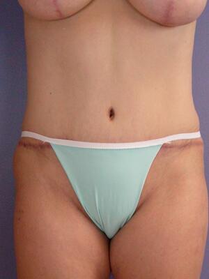 Tummy Tuck Before & After Image