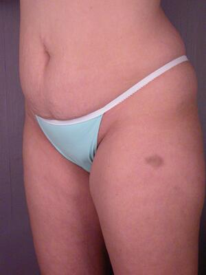 Tummy Tuck Before & After Image