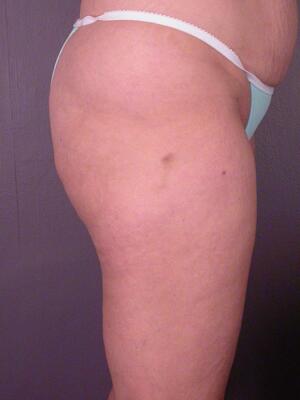 Tummy Tuck Before & After Image