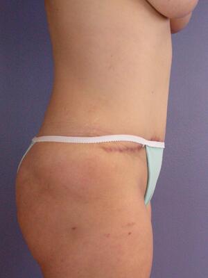 Tummy Tuck Before & After Image