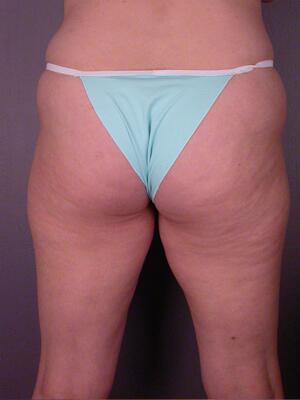 Tummy Tuck Before & After Image