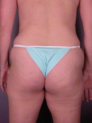 Tummy Tuck Before & After Image