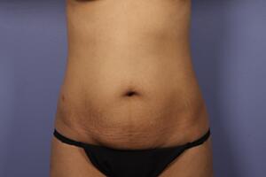 Tummy Tuck Before & After Image